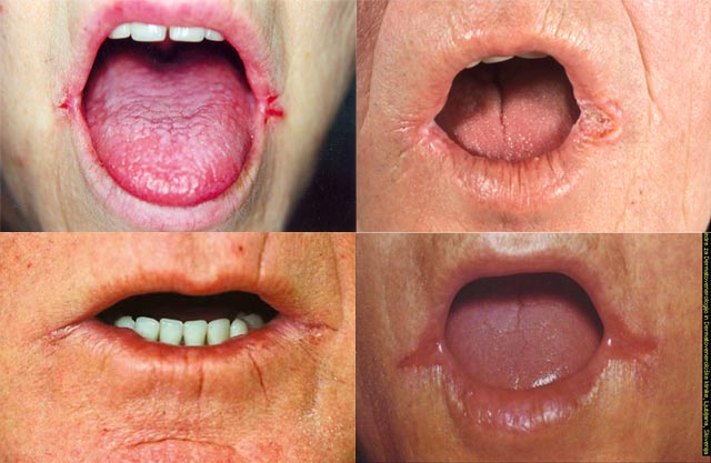 Pictures of older people with angular cheilitis
