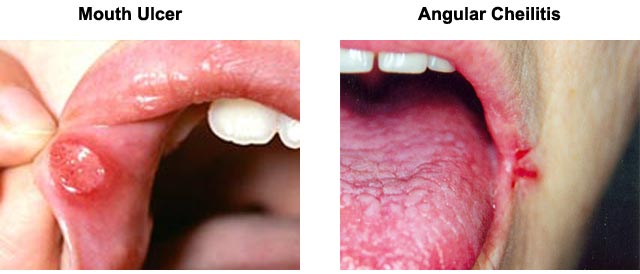 Mouth Ulcer vs Angular Cheilitis